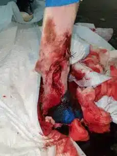 Клинические случаи 107 Повреждение кожного лоскута, связки и капсулы сустава, День операции